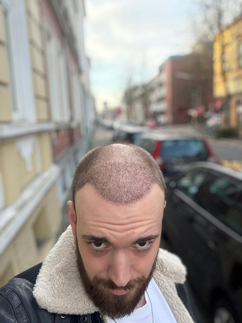 Die neue Haarlinie zeichnet sich ab.