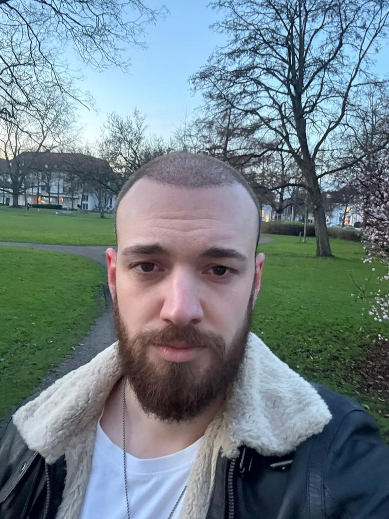 Die neue Haarlinie zeichnet sich ab.