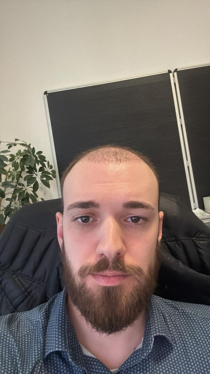 Die neue Haarlinie zeichnet sich ab.